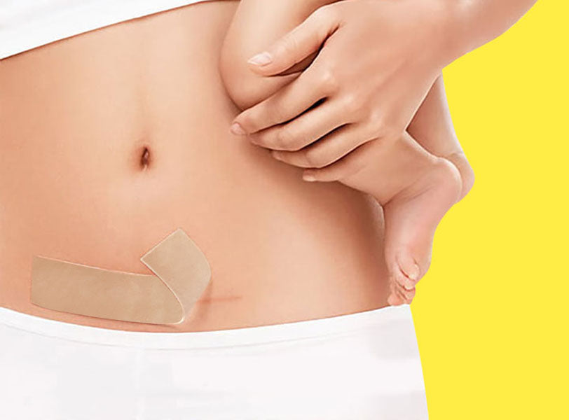 剖腹產或手術後的疤痕，如何有效祛除？